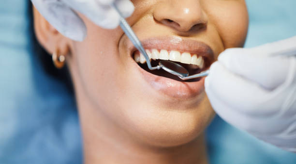 Best Emergency Wisdom Teeth Removal in La Presa, CA
